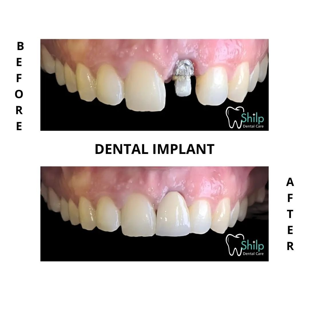 Dental-Implant before-and-after